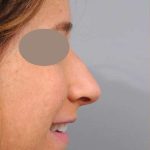 Rhinoplasty Before & After Patient #1572