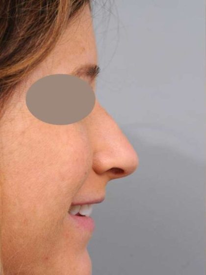 Rhinoplasty Before & After Patient #1572