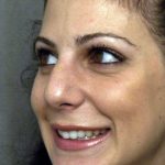 Rhinoplasty Before & After Patient #1579
