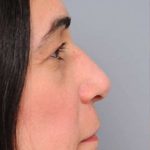 Rhinoplasty Before & After Patient #1586