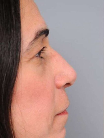 Rhinoplasty Before & After Patient #1586