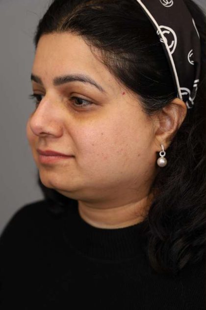 Neck Lift (Traditional) Before & After Patient #1605