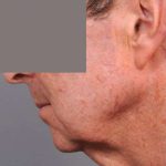 Neck Lift (Traditional) Before & After Patient #1612