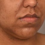 Neck Lift (Traditional) Before & After Patient #1621