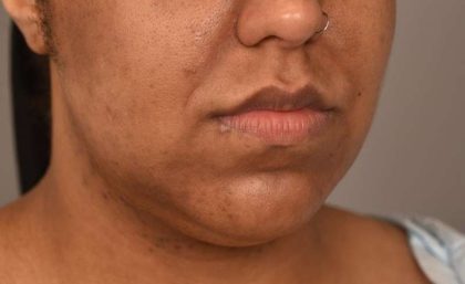 Neck Lift (Traditional) Before & After Patient #1621