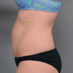 Tummy Tuck Before & After Patient #329