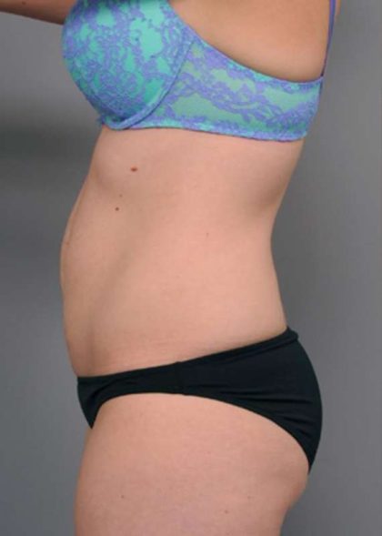 Tummy Tuck Before & After Patient #329