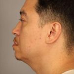 Mini Neck Lift (Single Incision) Before & After Patient #1630
