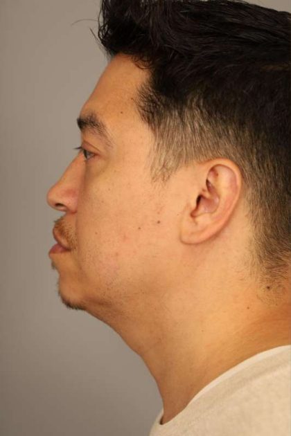 Mini Neck Lift (Single Incision) Before & After Patient #1630