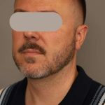 Mini Neck Lift (Single Incision) Before & After Patient #1653