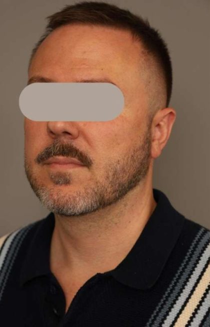 Mini Neck Lift (Single Incision) Before & After Patient #1653