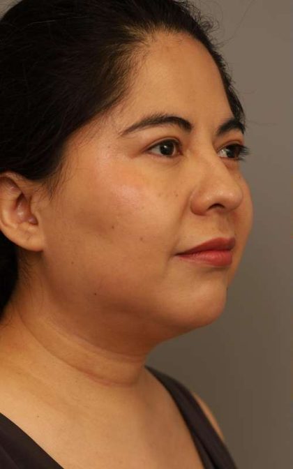 Mini Neck Lift (Single Incision) Before & After Patient #1662