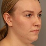 Mini Neck Lift (Single Incision) Before & After Patient #1690