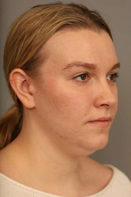Mini Neck Lift (Single Incision) Before & After Patient #1690