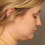 Neck Liposuction / Chin Liposuction Before & After Patient #1703
