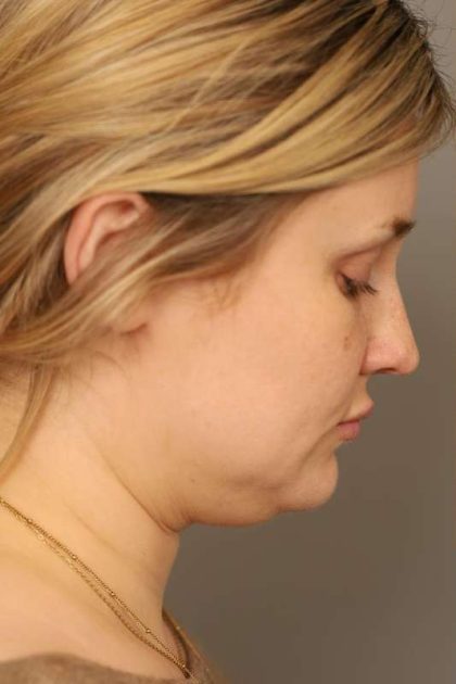 Neck Liposuction / Chin Liposuction Before & After Patient #1703