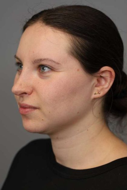 Neck Liposuction / Chin Liposuction Before & After Patient #1712