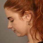 Neck Liposuction / Chin Liposuction Before & After Patient #1719