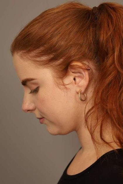 Neck Liposuction / Chin Liposuction Before & After Patient #1719