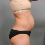 Tummy Tuck Before & After Patient #338