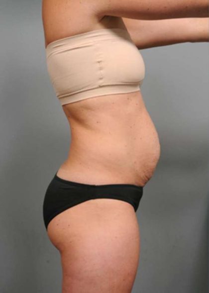 Tummy Tuck Before & After Patient #338
