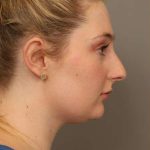 Neck Liposuction / Chin Liposuction Before & After Patient #1734