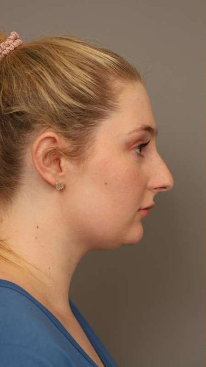 Neck Liposuction / Chin Liposuction Before & After Patient #1734