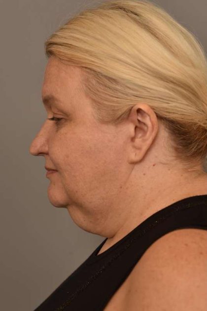 Neck Liposuction / Chin Liposuction Before & After Patient #1743