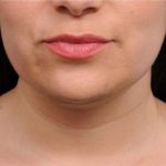 Neck Liposuction / Chin Liposuction Before & After Patient #1770