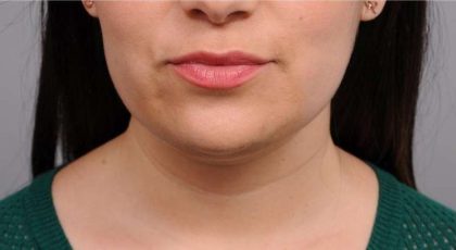 Neck Liposuction / Chin Liposuction Before & After Patient #1770