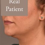 Neck Liposuction / Chin Liposuction Before & After Patient #1794