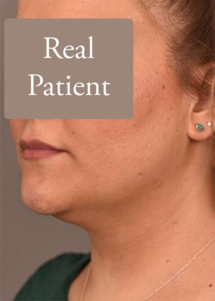Neck Liposuction / Chin Liposuction Before & After Patient #1794