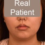 Neck Liposuction / Chin Liposuction Before & After Patient #1801