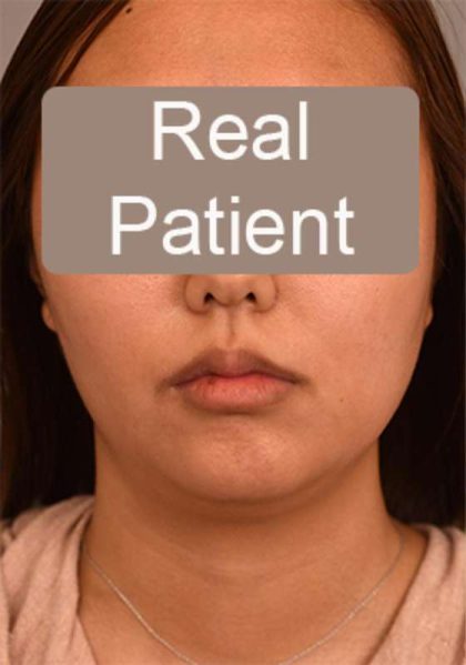 Neck Liposuction / Chin Liposuction Before & After Patient #1801