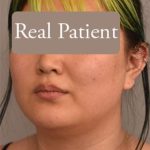 Neck Liposuction / Chin Liposuction Before & After Patient #1816