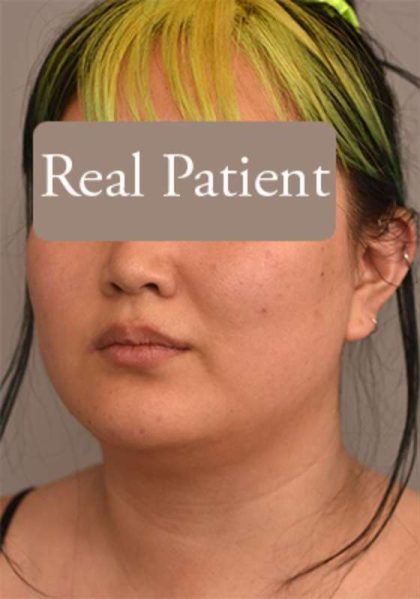 Neck Liposuction / Chin Liposuction Before & After Patient #1816