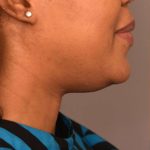 Neck Liposuction / Chin Liposuction Before & After Patient #1824