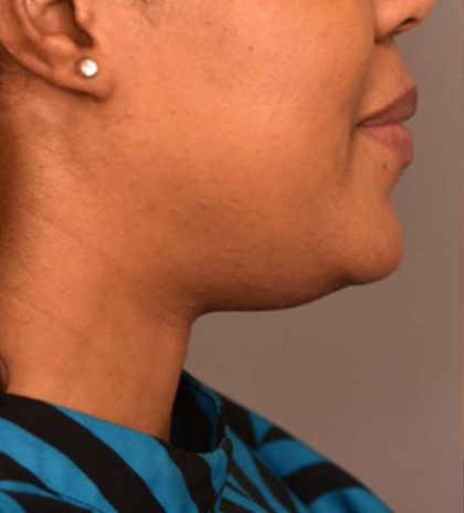Neck Liposuction / Chin Liposuction Before & After Patient #1824