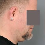 Neck Liposuction / Chin Liposuction Before & After Patient #1831
