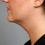 Neck Liposuction / Chin Liposuction Before & After Patient #1839