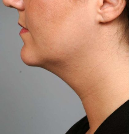 Neck Liposuction / Chin Liposuction Before & After Patient #1839