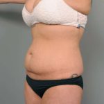Tummy Tuck Before & After Patient #345