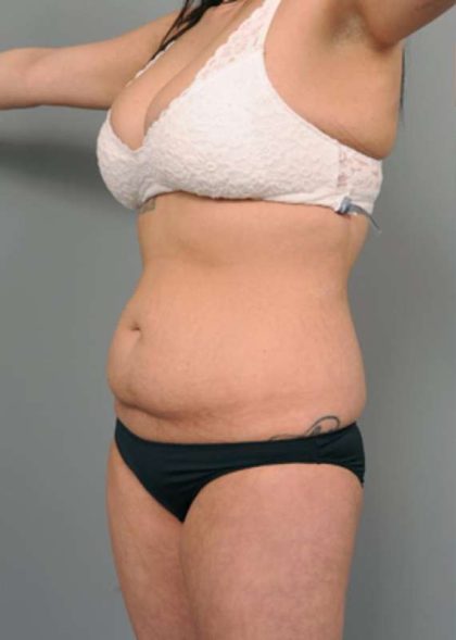 Tummy Tuck Before & After Patient #345