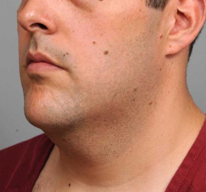 Neck Liposuction / Chin Liposuction Before & After Patient #1846