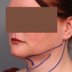 Neck Liposuction / Chin Liposuction Before & After Patient #1854