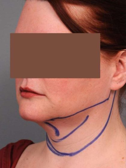 Neck Liposuction / Chin Liposuction Before & After Patient #1854