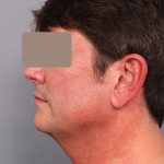 Neck Liposuction / Chin Liposuction Before & After Patient #1877