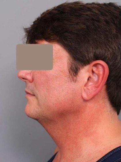 Neck Liposuction / Chin Liposuction Before & After Patient #1877
