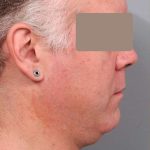 Neck Liposuction / Chin Liposuction Before & After Patient #1886