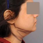 Neck Liposuction / Chin Liposuction Before & After Patient #1893